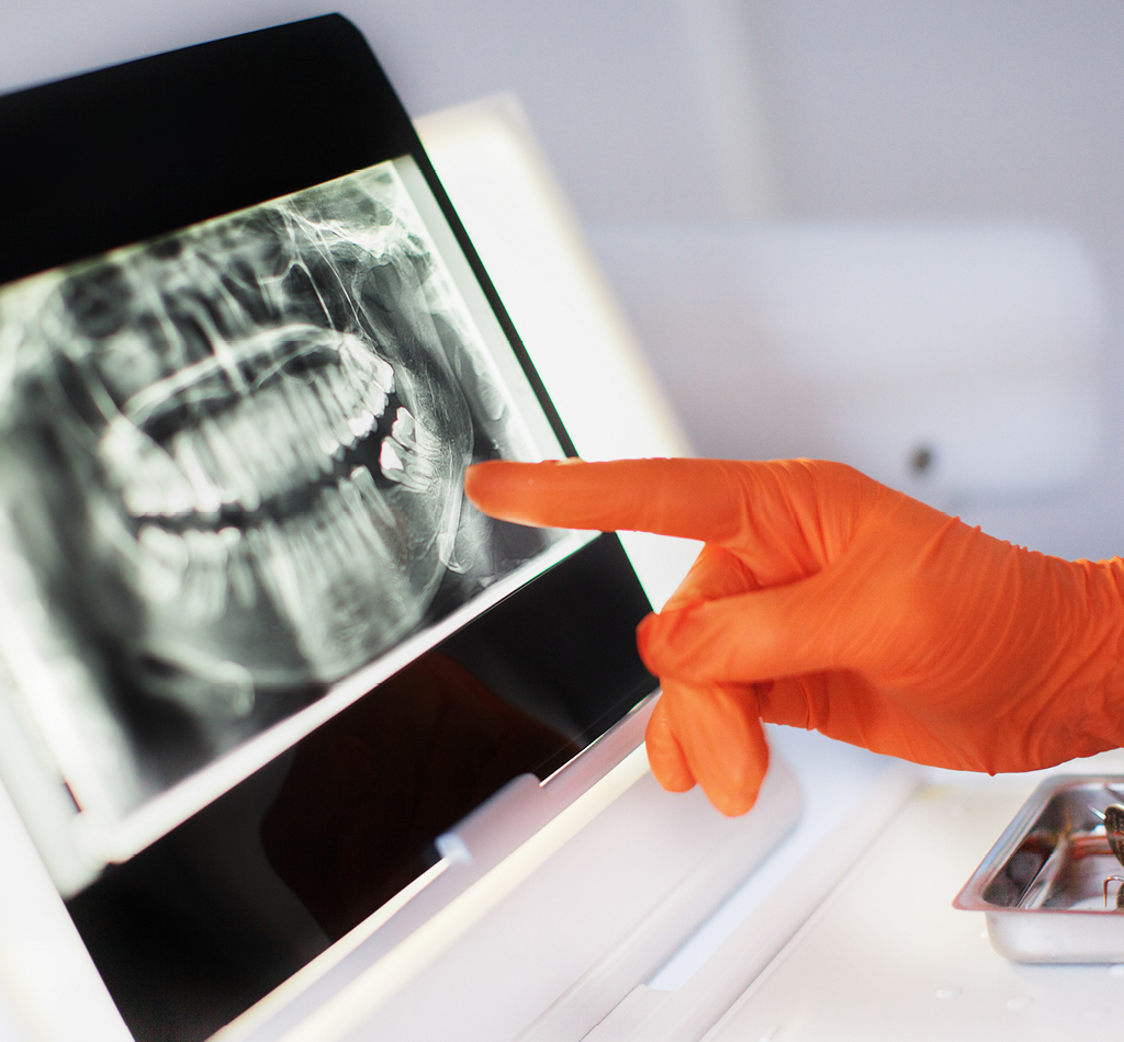 Dentist medical tools - gloved hand pointing to computer displaying X-ray of teeth and jaw